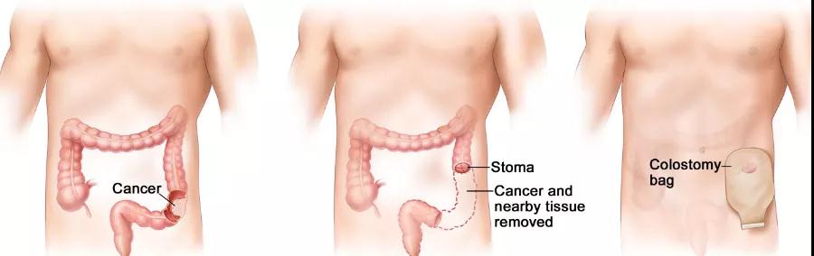 直肠癌手术治疗