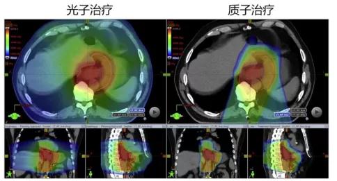 质子重离子治疗食管癌