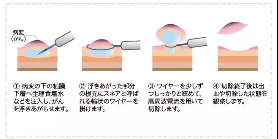 食管癌内镜治疗