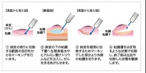 食管癌内镜治疗