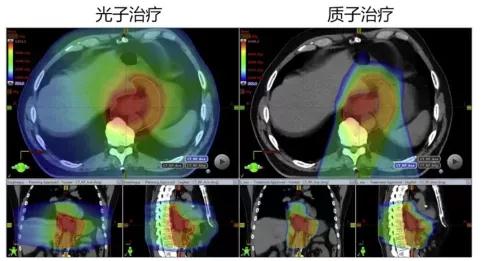 质子治疗食管癌