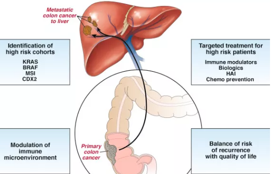 肠癌肝转移手术治疗