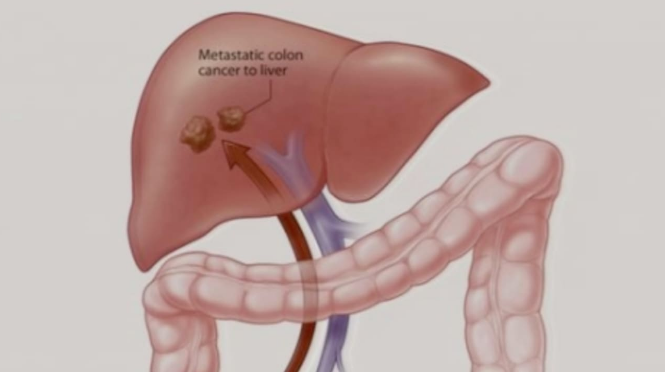 降低肠癌肝转移复发风险