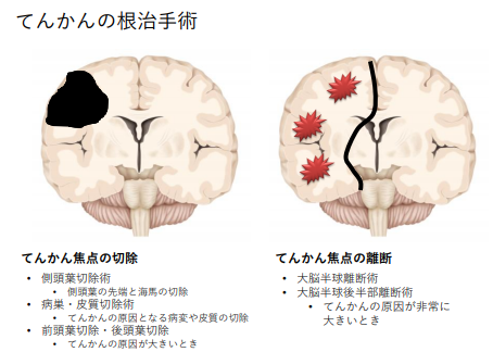 癫痫日本手术治疗