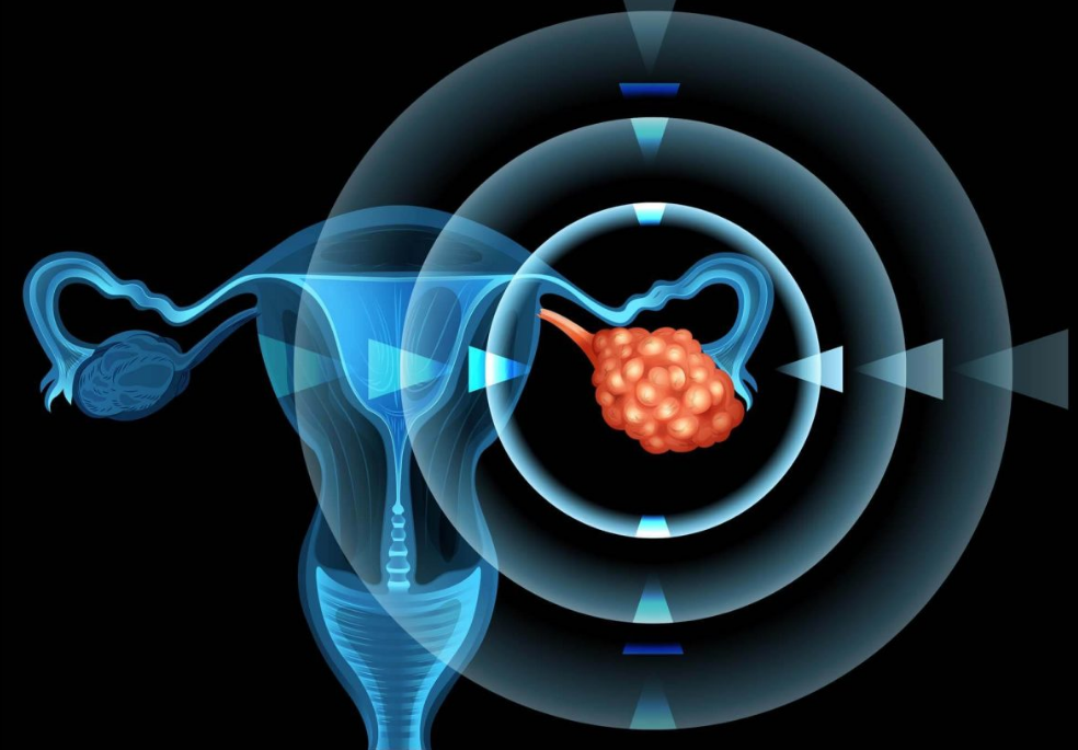 卵巢癌靶向药新药