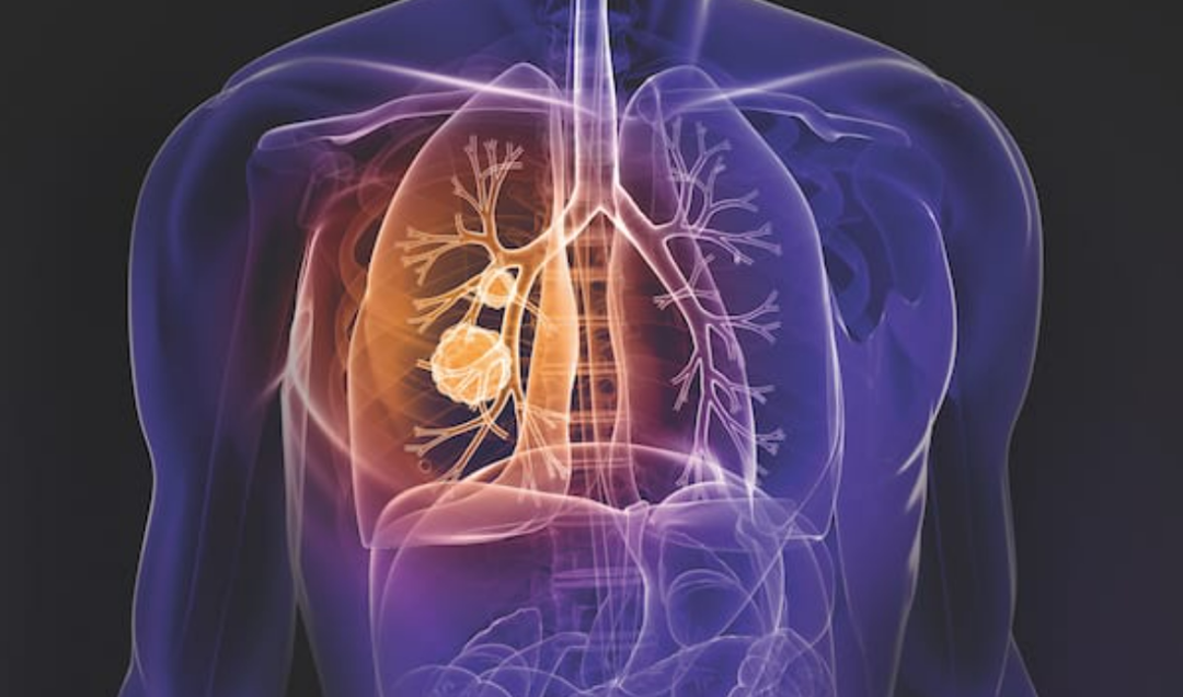 美国肺癌治疗