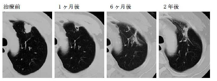 肺癌质子重离子治疗