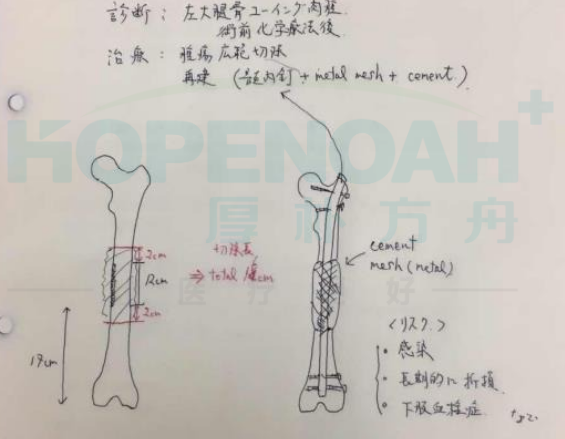 日本尤文氏肉瘤治疗案例