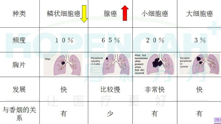 肺癌分型