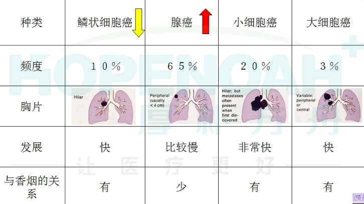 小细胞肺癌出国看病