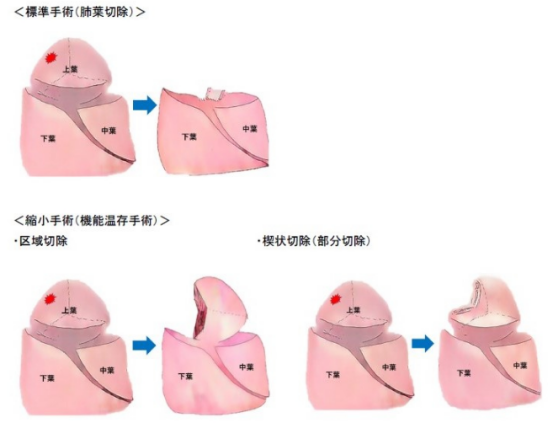 肺癌能治好吗