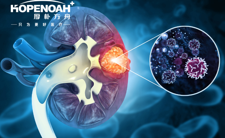国外肾癌生存率-日本肾癌治疗方法