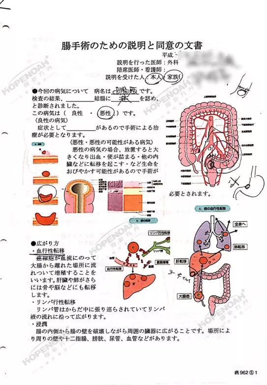 日本直肠癌保肛