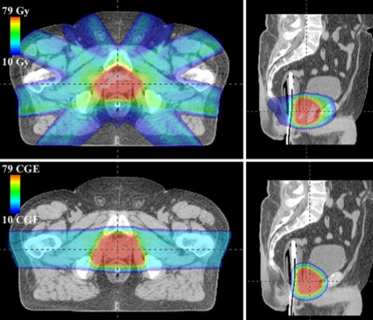 前列腺癌放疗
