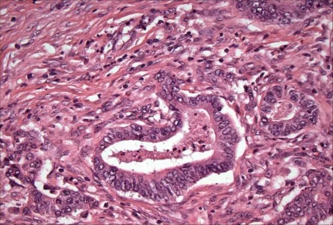 ▲结肠癌示意图，可清晰看到癌细胞呈圈状结构