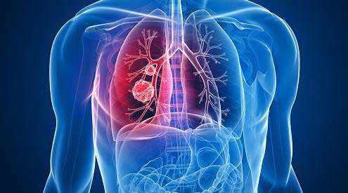 转移性肺癌治疗