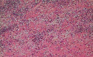 腹膜后恶性肿瘤治疗