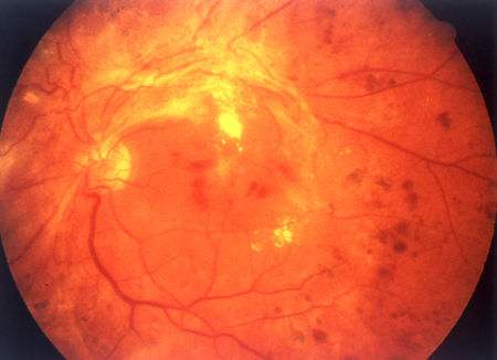 视网膜脱落治疗