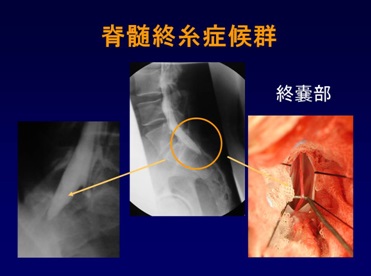 脊髓终丝症候群,腰椎间盘突出