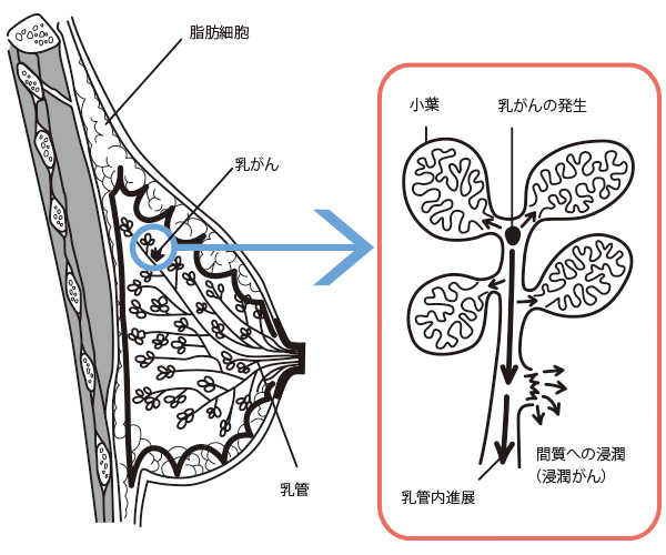 乳腺癌日本看病，乳腺癌出国看病