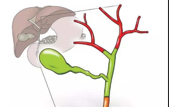 胆囊癌怎么治，胆囊癌能治好，胆囊癌治疗的先进技术