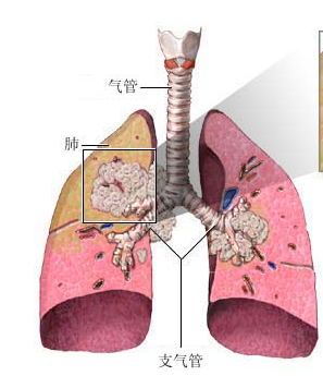 答:在临床上根据肺癌组织的癌细胞病理特征分为非小细胞肺癌(nsclc)