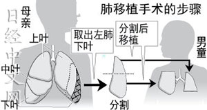 日本成功实施全球较精细活体肺移植手术（图）