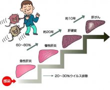 肝炎治疗技术,乙型肝炎治疗，乙型肝炎治疗技术