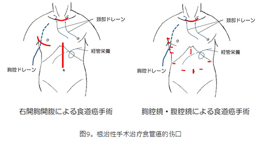 食道癌手术切口图解图片