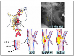 日本,看病,颈动脉,狭窄,治疗,医院,介绍,庆应,