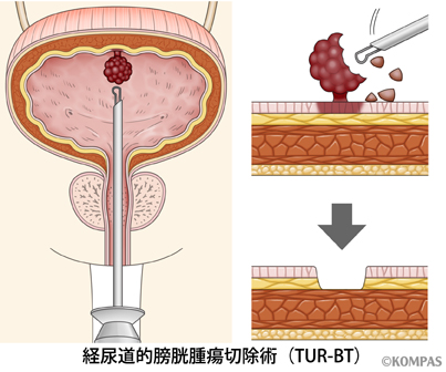 尿道恶性肿瘤图片
