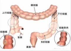 直肠癌，低位直肠癌保肛手术，三井纪念病院，顺天堂浦安医院
