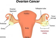 卵巢癌,卵巢癌治疗,卵巢癌治疗药物