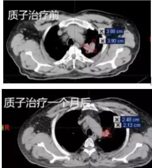 质子治疗