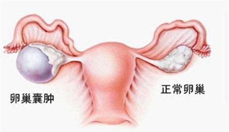 卵巢囊肿