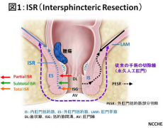 直肠癌，低位直肠癌保肛手术，三井纪念病院，顺天堂浦安医院