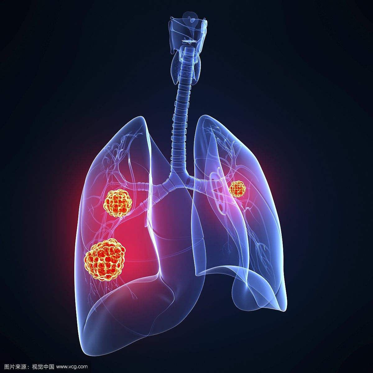 刘懿博士说肺癌（三五四）“冰山之巅”-肺类癌典型CT表现 - 好大夫在线