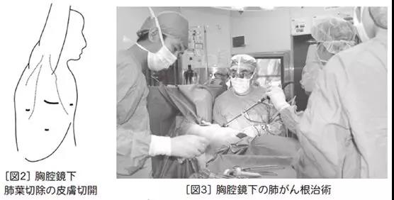 中美日肺癌手术