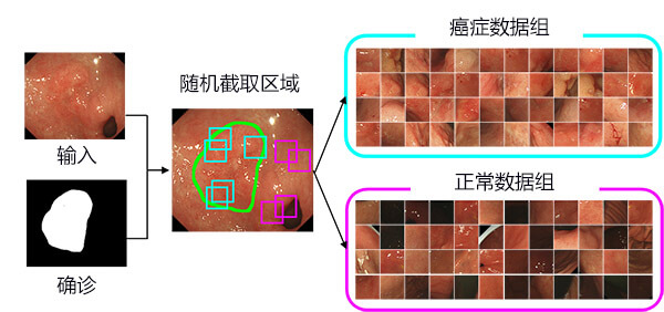 AI高精度检测早期胃癌