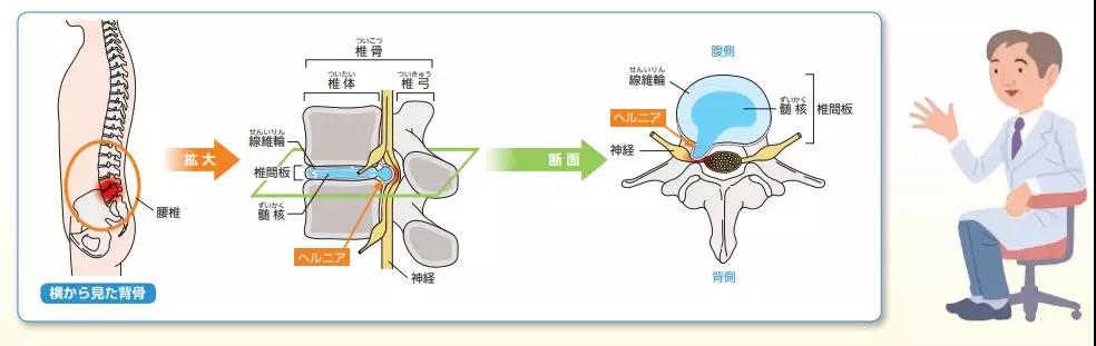 腰间盘突出治疗技能