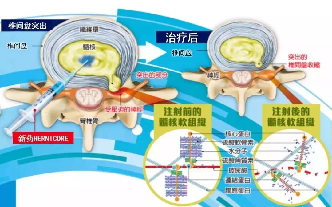 腰间盘突出