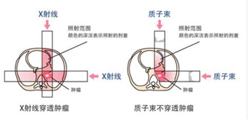 日本质子治疗