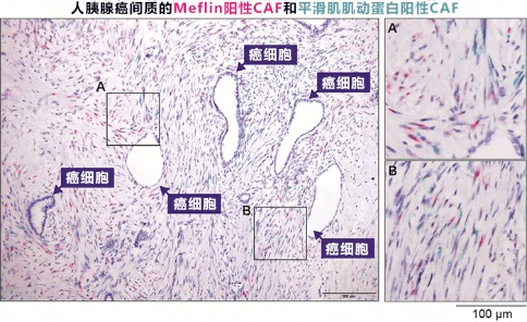 胰腺癌出国治疗：这种细胞竟然可以抑制胰腺癌生长？