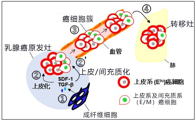 乳腺癌出国治疗：日本研究人员发现乳腺癌浸润转移新机制！