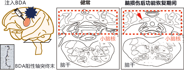 出国看病：研究发现大脑损伤后会形成新的神经束，或可治疗脑部疾病