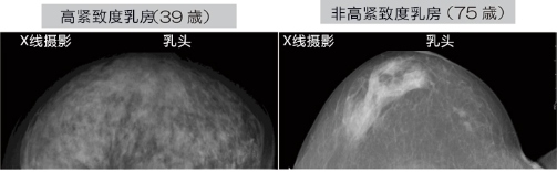 乳腺癌如何检查？日本开发出一种新技能可用于早期检测乳腺癌