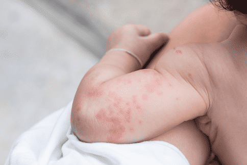 出国看病：麻疹卷土重来是什么原因？新研究对此进行了揭示