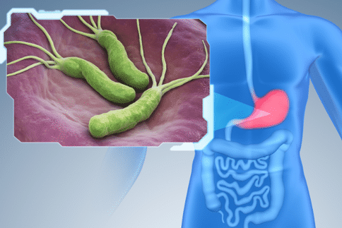 胃癌风险与幽门螺旋杆菌