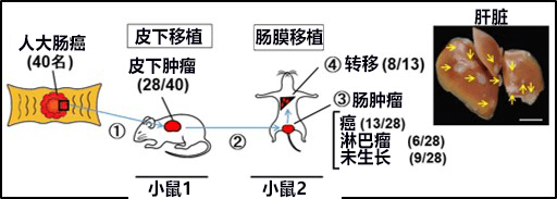 大肠癌转移治疗新靶点