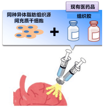 日本开发出一种治疗心力衰竭的新技能，目前已进行临床试验！